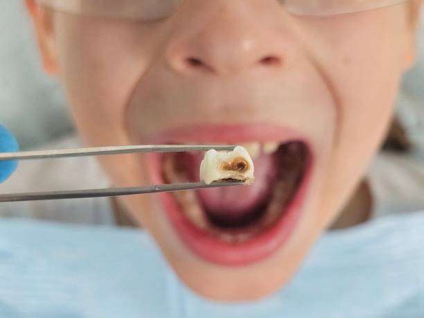 Best Dentist for Tooth Abscess  in Armada, MI